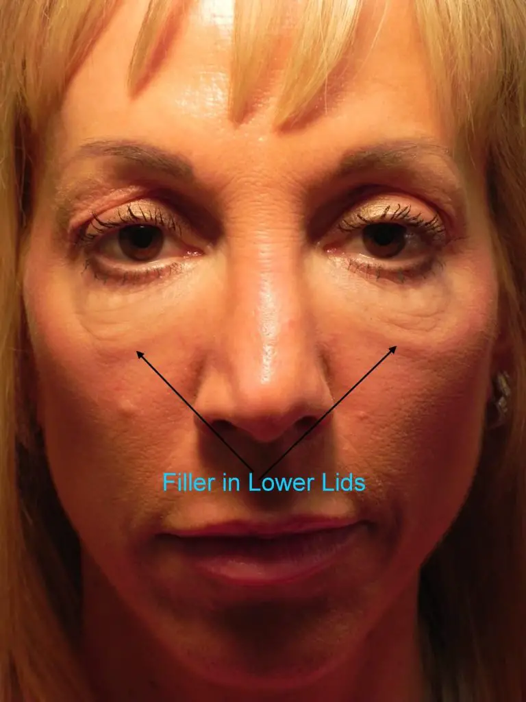 How to Dissolve under Eye Filler at Home