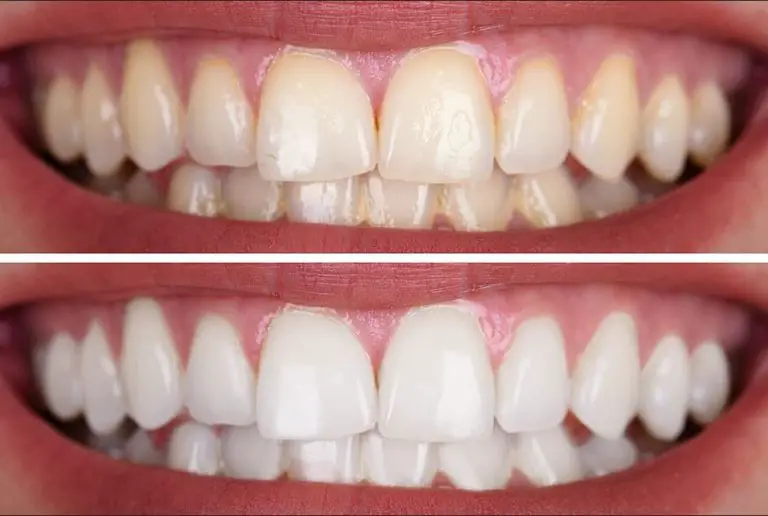 How Often Can You Whiten Your Teeth at Home