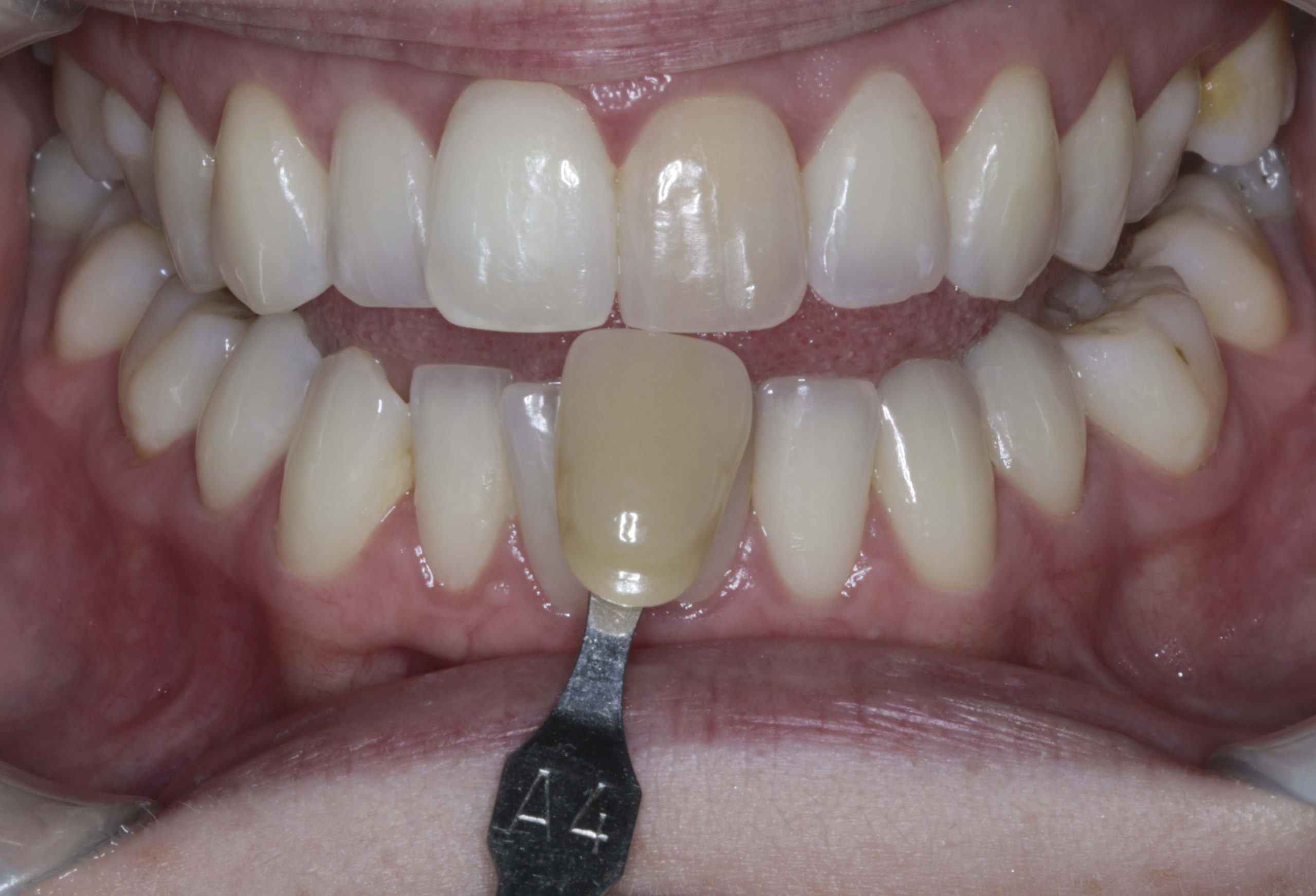 How to Fix One Discolored Tooth at Home