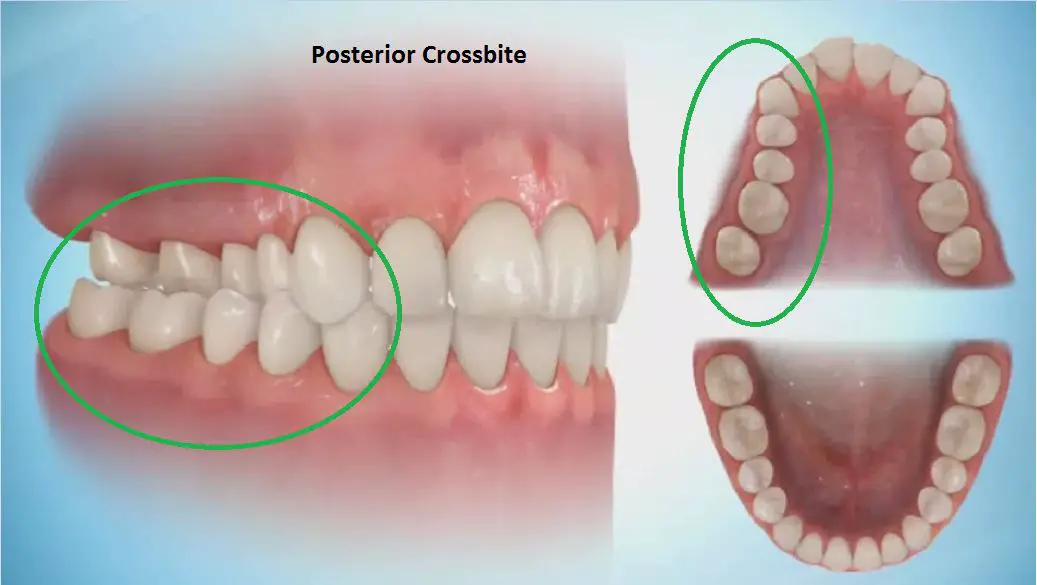 Crossbite Correction in Adults Without Surgery