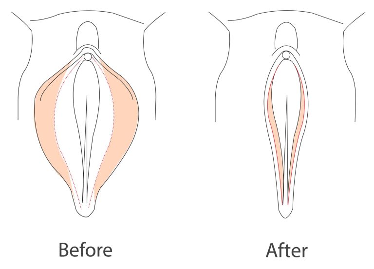 Do Labia Get Bigger With Age?