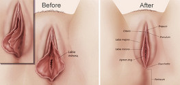 Can You Fix A Stretched Labia?